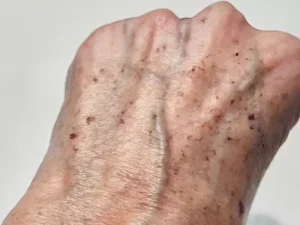 Revitalize Your Skin with IPL Treatment: Solutions for Pigmentation, Acne, and More