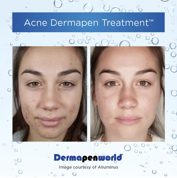 Comprehensive Guide to Acne Treatments: Hydrofacials, Microneedling, and IPL PhotoFacials Explained