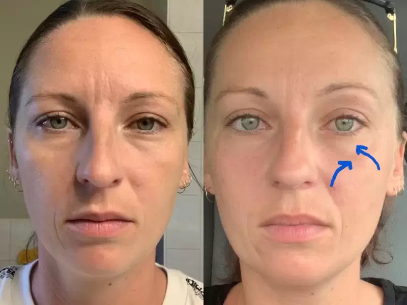 Dermal Fillers Near Me: How They Work and How They Can Transform Your Look