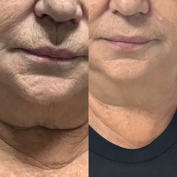 The Benefits of HIFU Facial Treatment