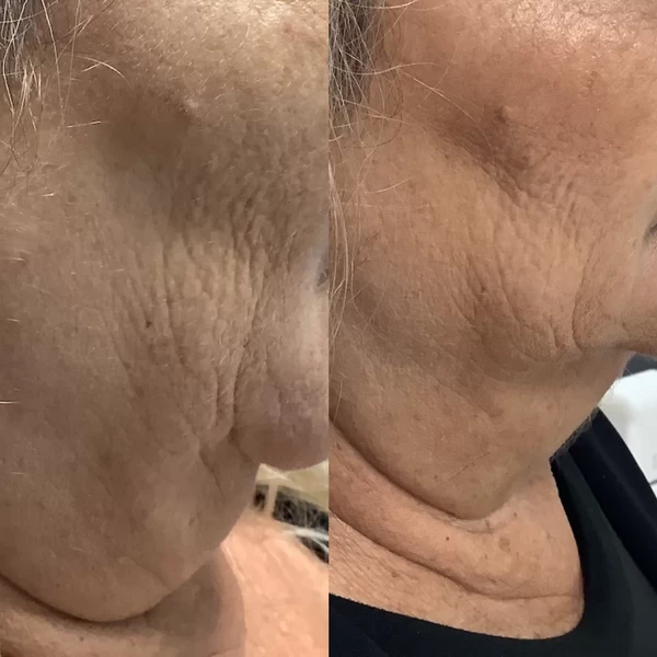 The Benefits of HIFU Facial Treatment