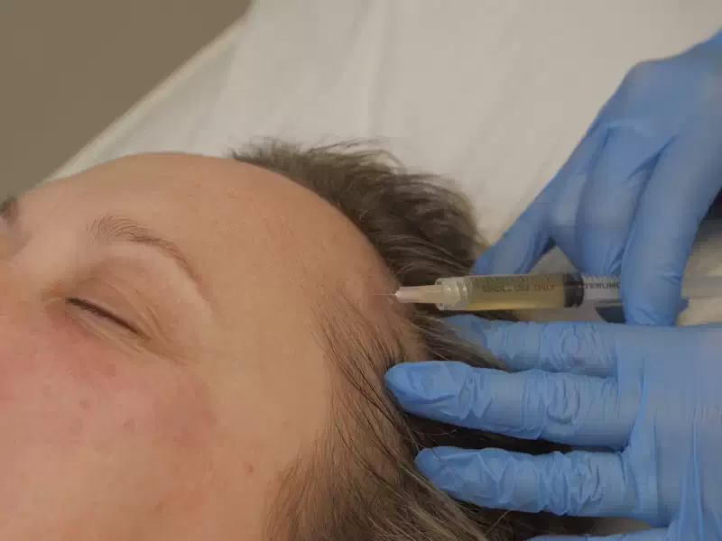 PRP Treatment Near Me for Hair Regrowth: Your Solution to Hair Loss