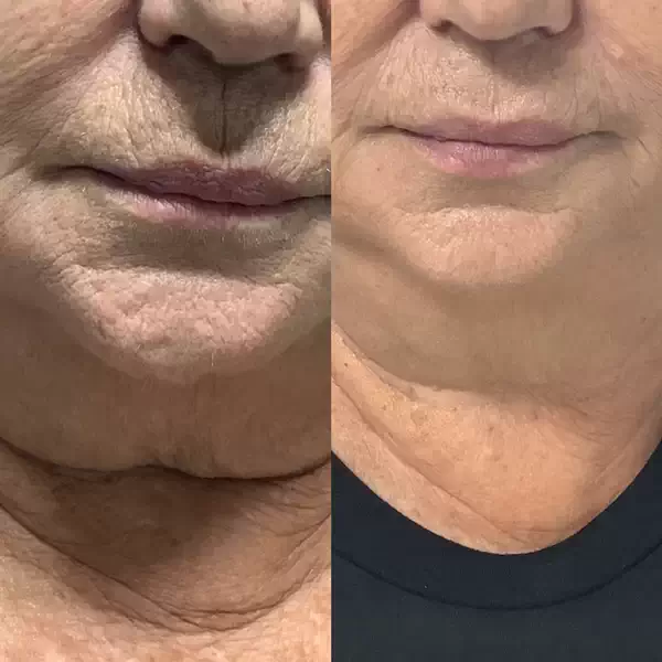 HIFU Brampton: Why Residents of Brampton are Choosing HIFU Treatments?