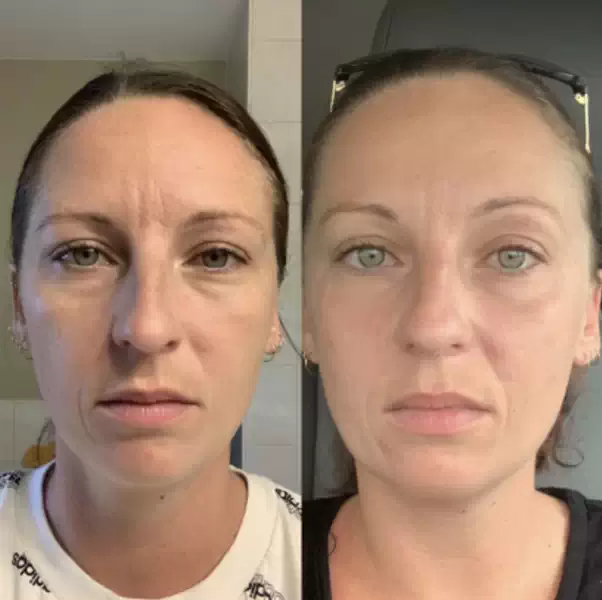 Dermal Fillers in Mississauga | What Are Dermal Fillers