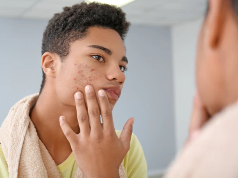 How Acne Treatments Can Help