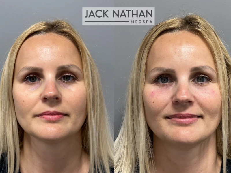 Biggest Myths about Dermal Fillers