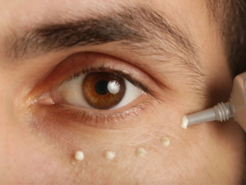 Dark Circles: Causes, Solutions, and Effective Treatments
