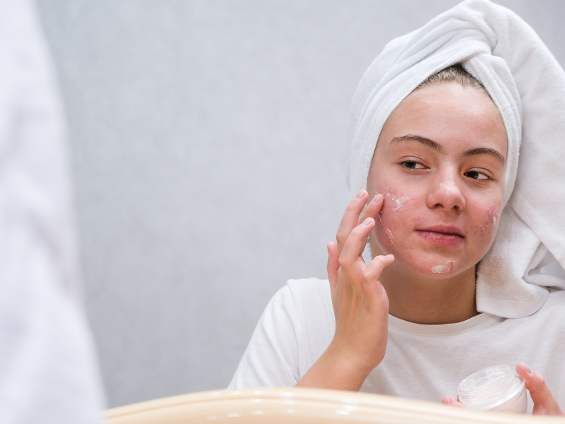 The Absolutely Best Teenage Acne Treatments You Need To Know About