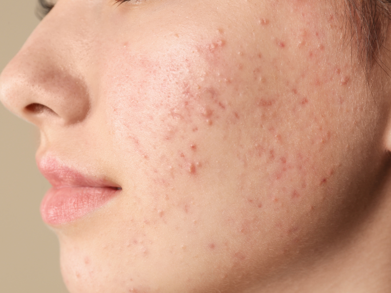 The Absolutely Best Teenage Acne Treatments You Need To Know About