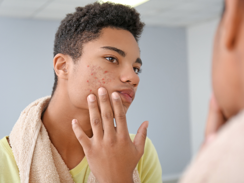The Absolutely Best Teenage Acne Treatments You Need To Know About