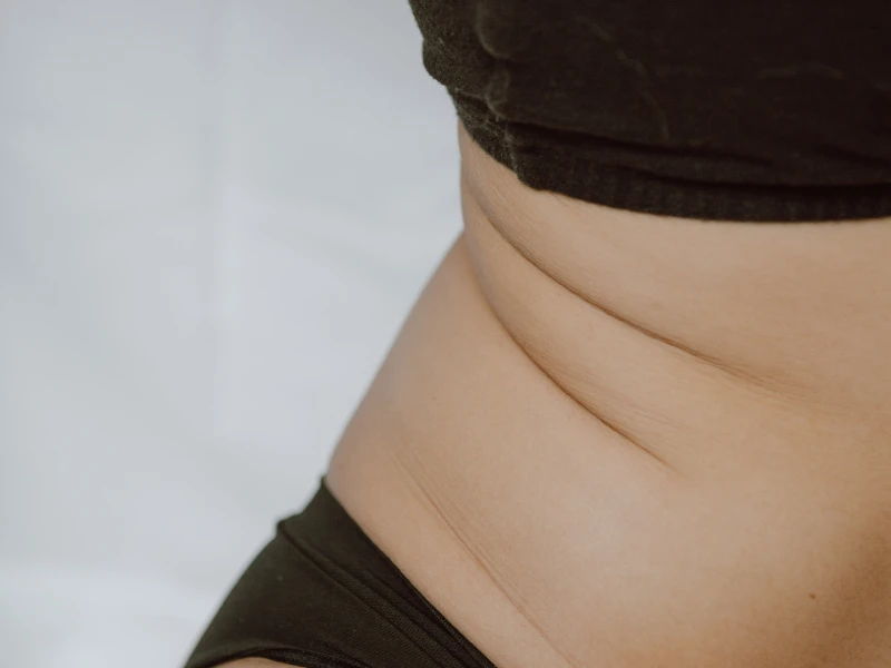 Top 7 Frequently Asked Questions about Cool Form and Skin Laxity