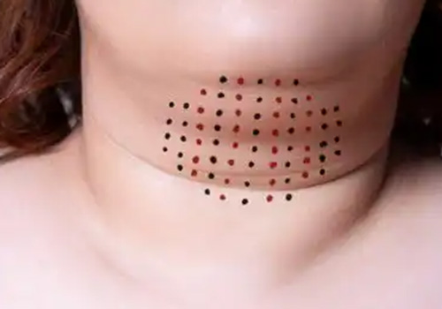 Chin Reduction