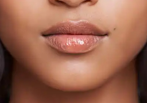 Dermal Fillers