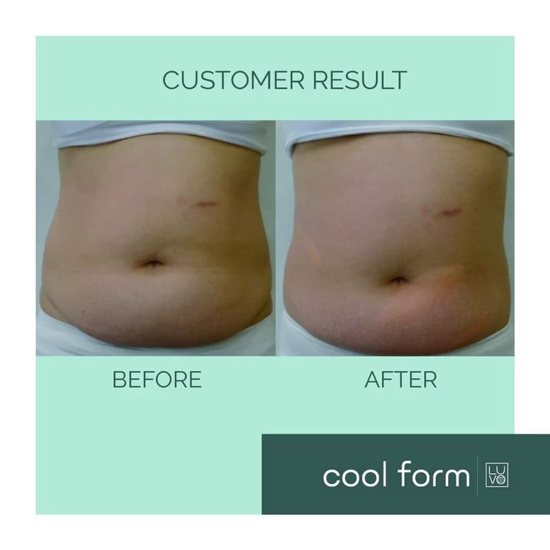 Before After Cool Form Fat Reduction