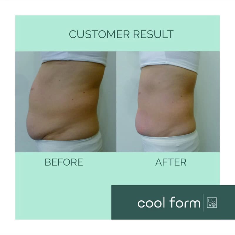 Before After Picture Fat Reduction with Cool Form
