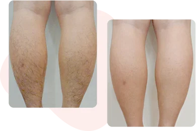 Laser Hair Removal – Before and After