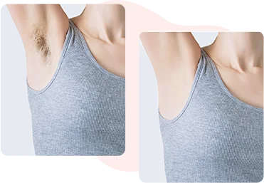 Laser Hair Removal – Before and After