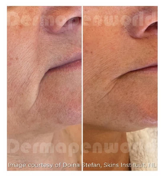 Exosomes Treatment in Skincare