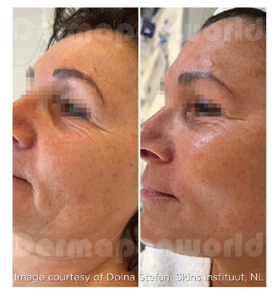 Exosomes Treatment in Skincare