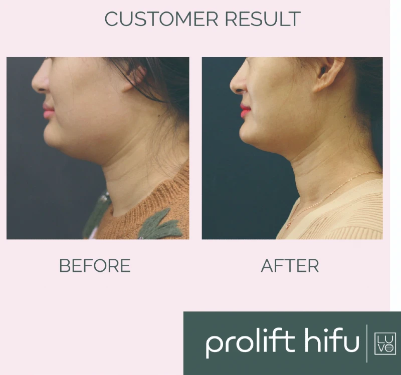 How to Prepare for a HIFU Skin Ultrasound Treatment To See Great Results
