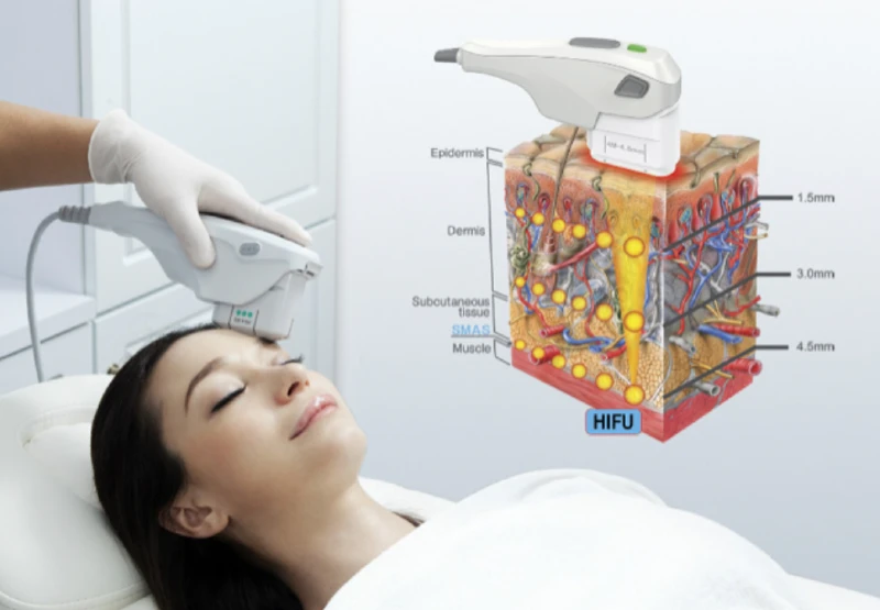 How to Prepare for a HIFU Skin Ultrasound Treatment To See Great Results
