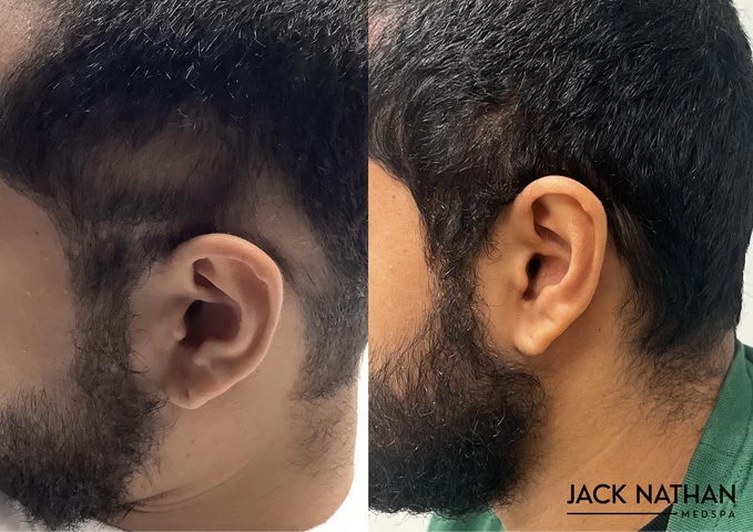 PRP Hair Restoration
