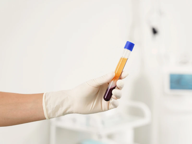 How to Get the Best Results From Your PRP Hair Treatments