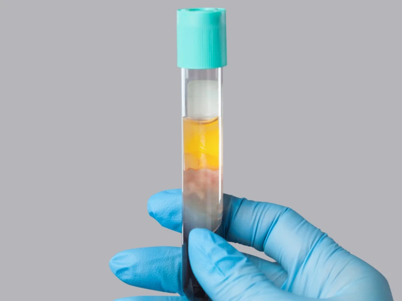 How to Get the Best Results From Your PRP Hair Treatments