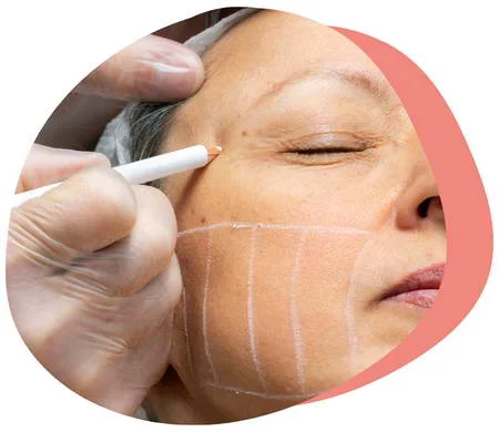 HIFU Facial Treatment