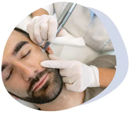 Radiofrequency Microneedling
