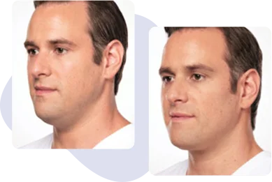 chin reduction male