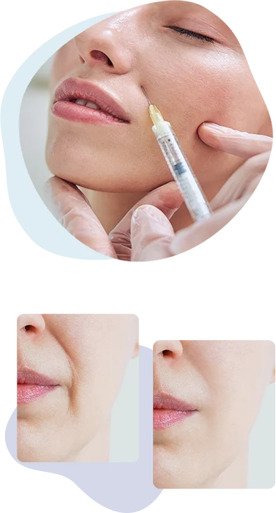 Fillers