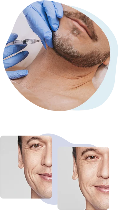 fillers