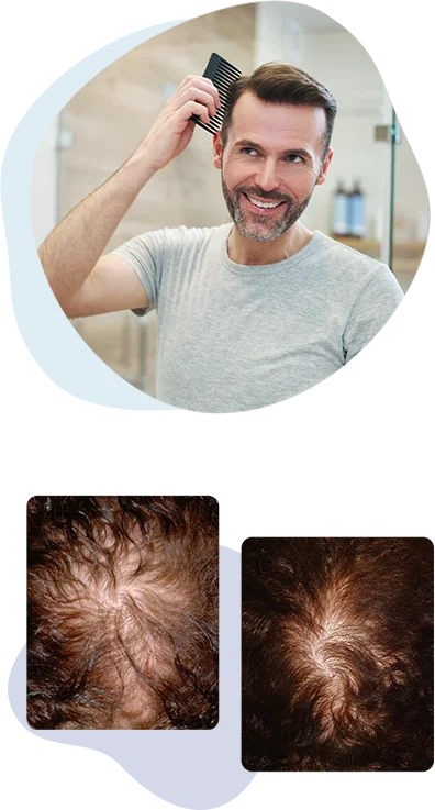 PRP Hair Restoration