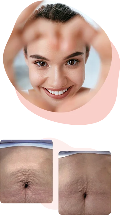 Radiofrequency Microneedling