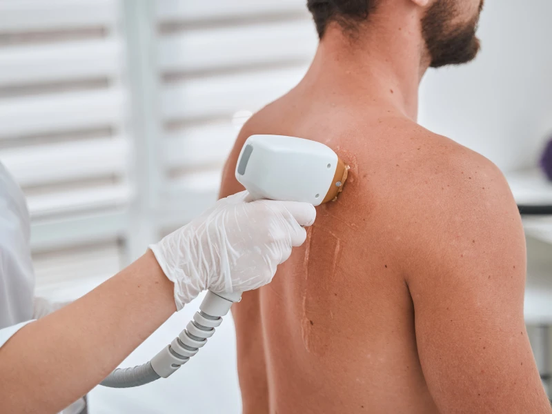 How to know if Laser Hair Removal is Right For You?