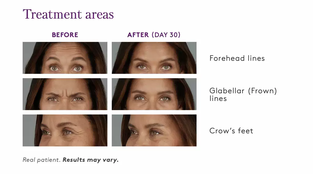 botox-before-and-after